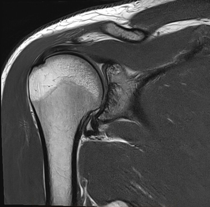 MRI RT SHOULDER 0002 1 scaled 1