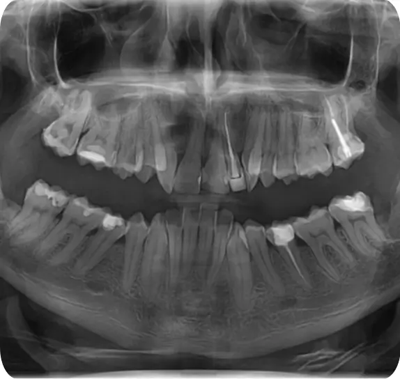 radiografie dentara ortopantomografie edenta