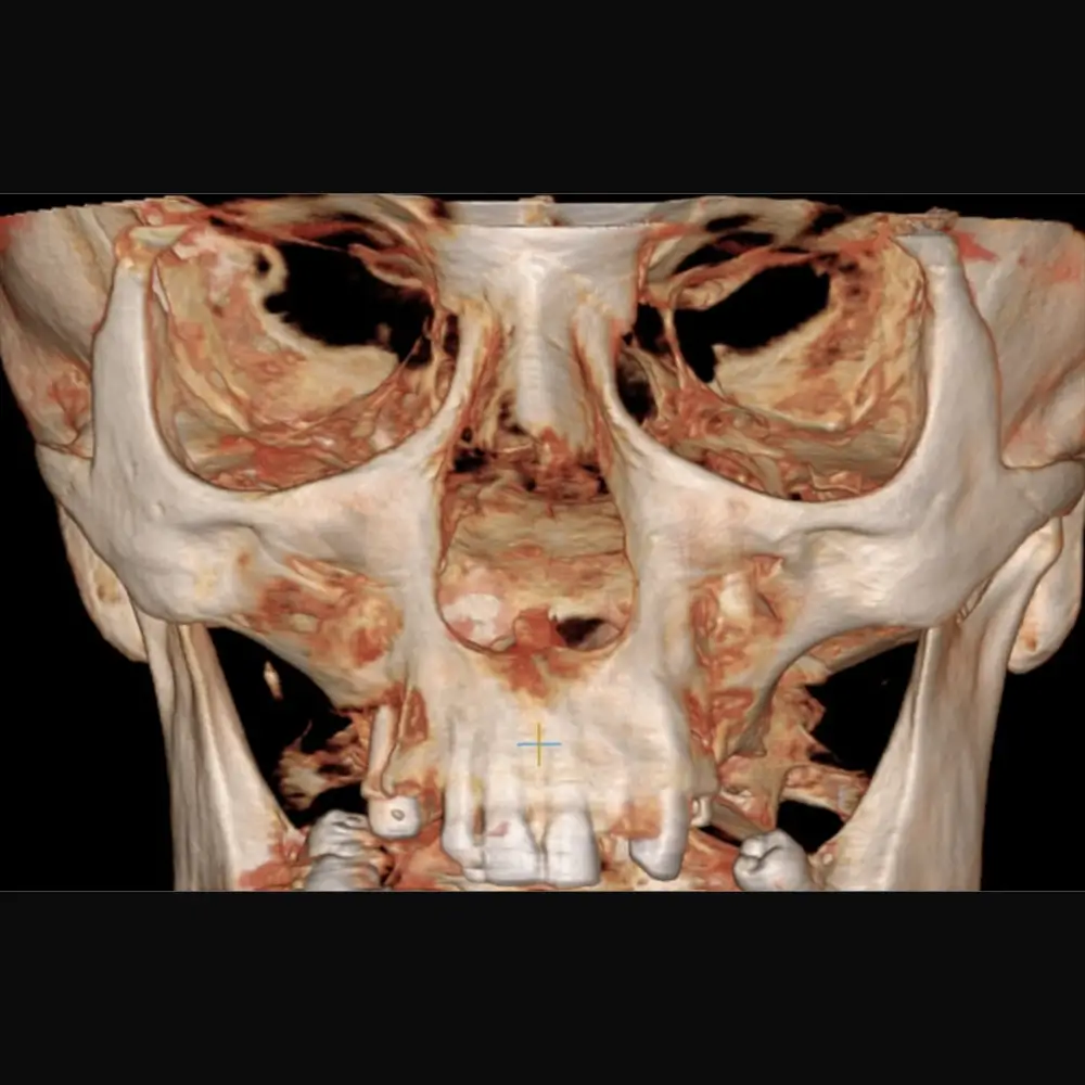 cbct dentar edenta radiologie