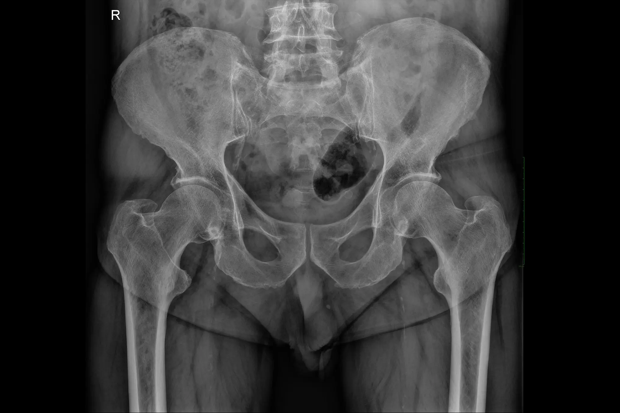 radiografie bazin edenta radiologie