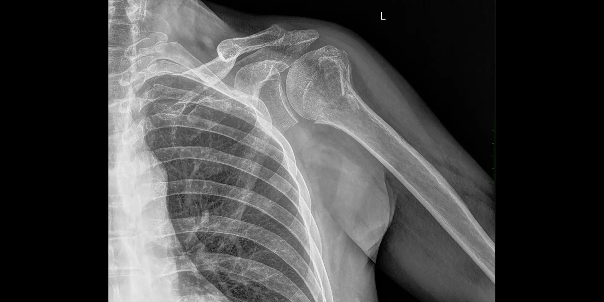 radiografie humerus p edenta radiologie