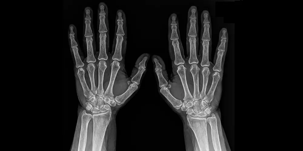 radiografie maini edenta 2