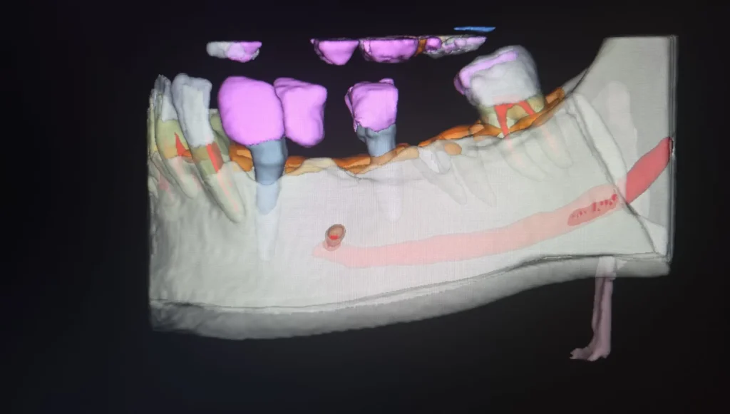 Segmentarea automată în Endodonție: Cum optimizează modulul Segmentation tratamentele pe canal 1 segmentation endodontie edenta radiologie iasi 1