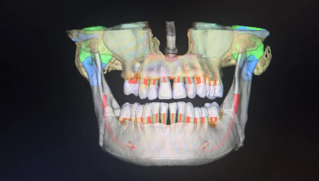 Segmentarea automată în Endodonție: Cum optimizează modulul Segmentation tratamentele pe canal 2 segmentation endodontie edenta radiologie iasi 2