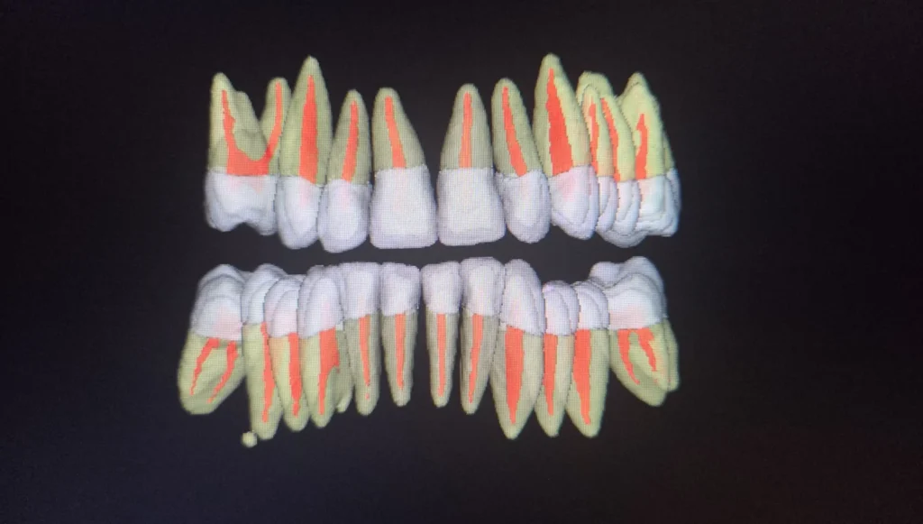 Segmentarea automată în Endodonție: Cum optimizează modulul Segmentation tratamentele pe canal 3 segmentation endodontie edenta radiologie iasi 3