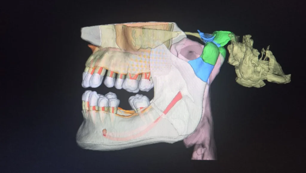 Segmentarea automată în Endodonție: Cum optimizează modulul Segmentation tratamentele pe canal 4 segmentation endodontie edenta radiologie iasi 4